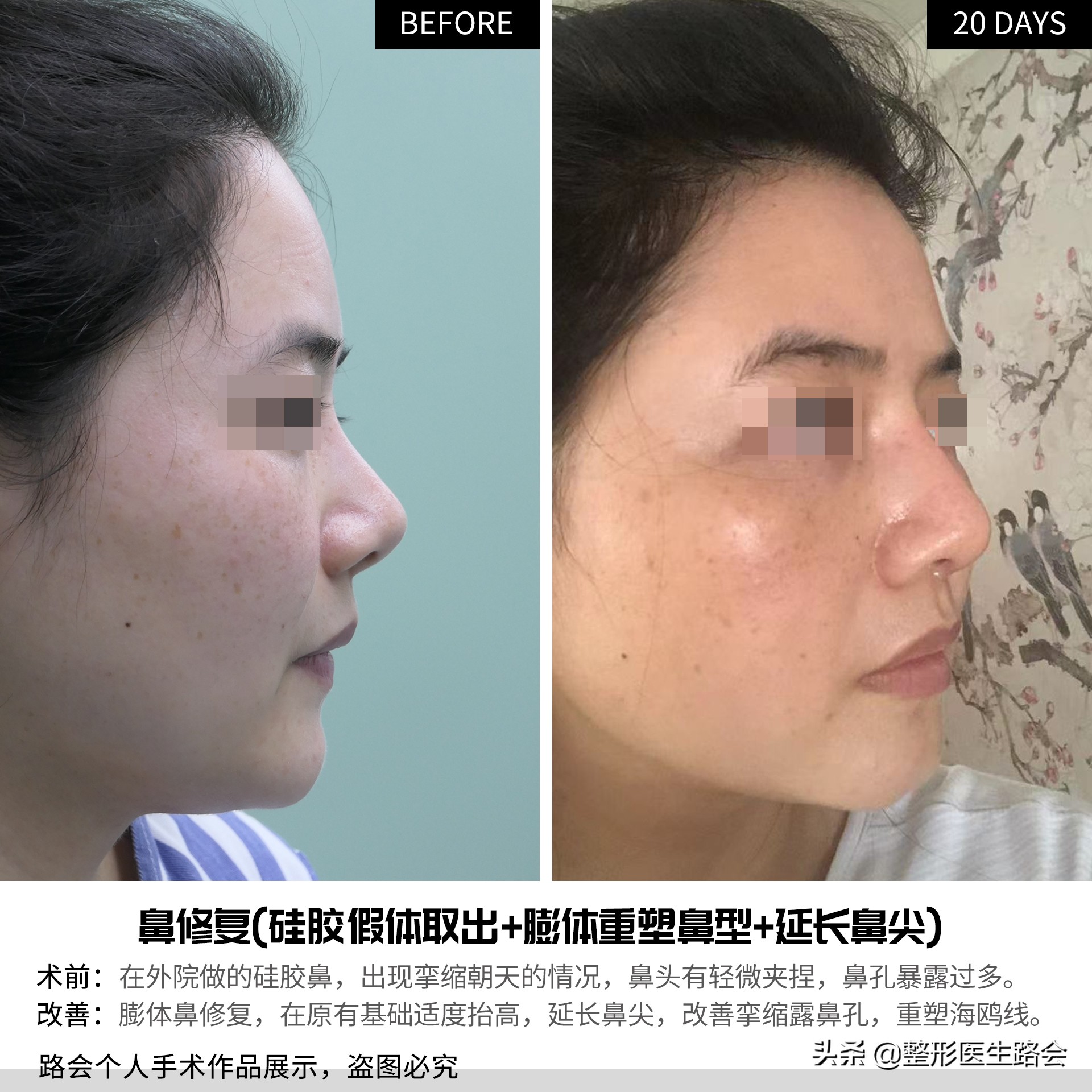 为什么隆鼻很久了鼻子还会歪,隆鼻了怎么确定鼻型歪不歪