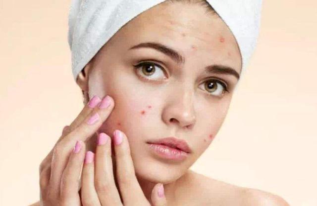 长痘痘应该如何正确处理,长痘痘的好处与坏处