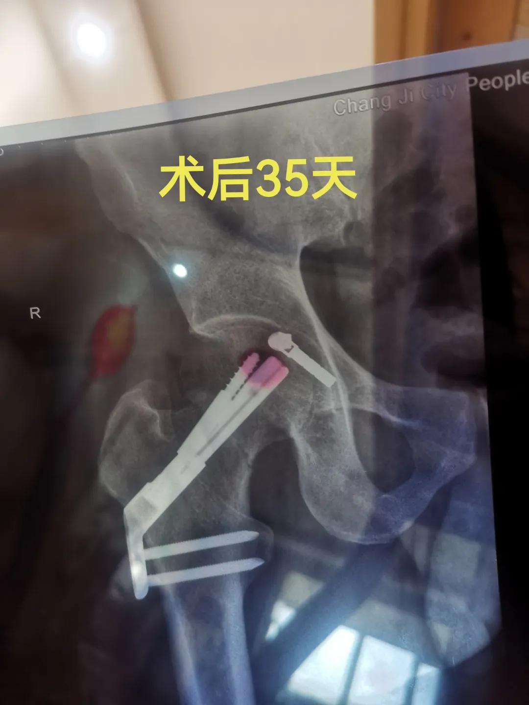 股骨颈骨折康复治疗,股骨颈骨折内固定康复