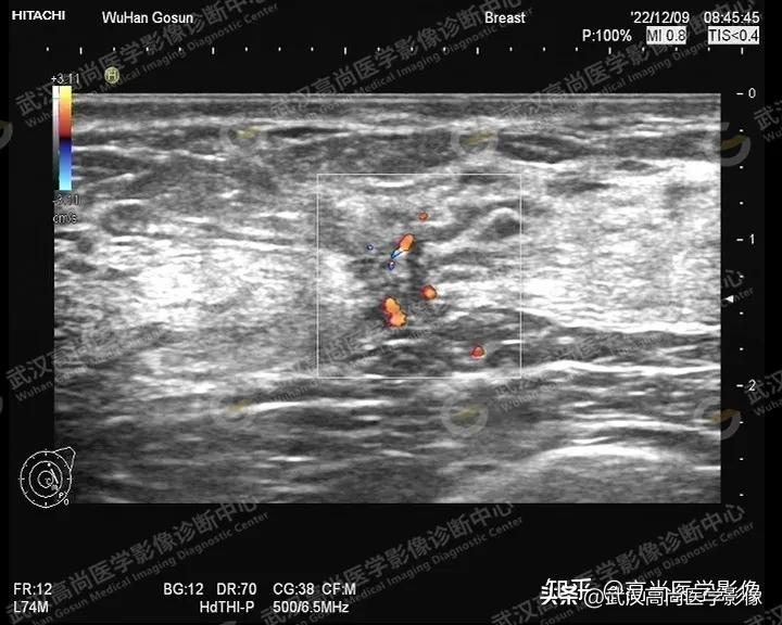 乳腺超声病例,乳腺肿块巨大超声结果4a