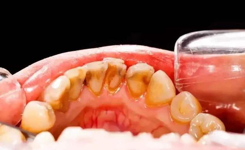 口腔溃疡很痛有什么方法治疗,特别疼的口腔溃疡怎么好