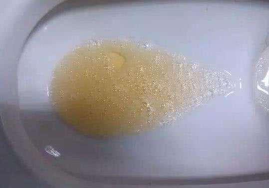 排尿很黄异味很大是什么病的信号,排尿很黄还有分泌物怎么回事