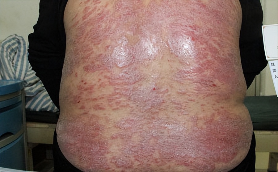 银屑病中医彩色图谱,银屑病舌象分型