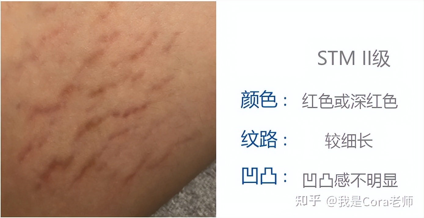 妊娠纹用什么方法可以修复,妊娠纹可以修复吗