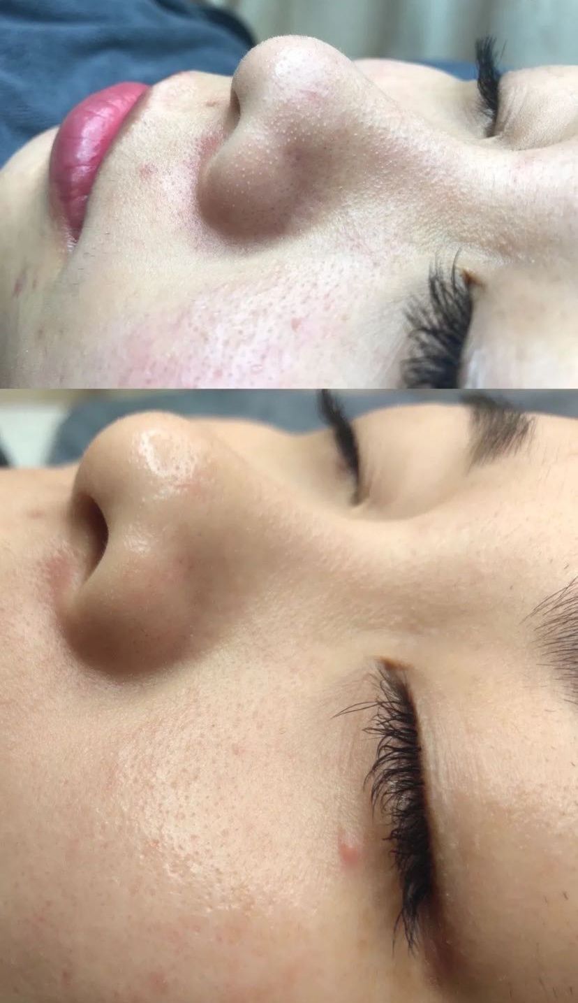 鼻子上油脂粒去除后怎么收缩毛孔,鼻子上长了个类似痘的东西