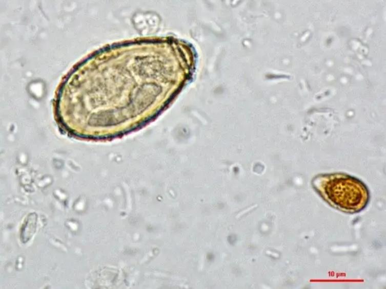 人体内肝吸虫与寄生虫区别,如果是寄生虫感染肝脏要不要吃药
