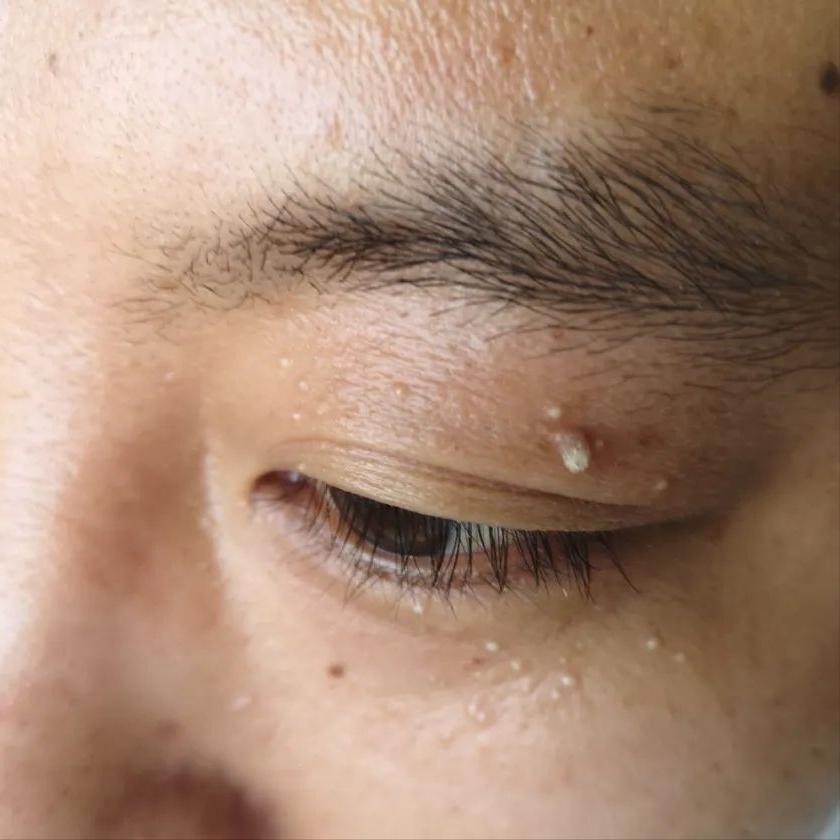 hpv病毒引起的疣是什么,hpv引起的病毒疣