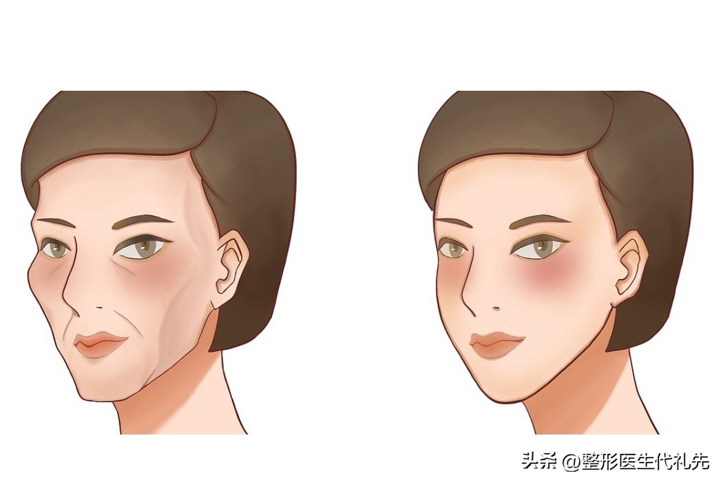 脸颊凹陷严重怎么办,天生脸颊凹陷怎么改善
