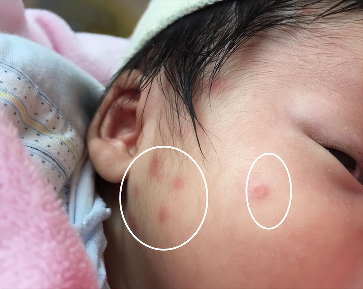 宝宝夏天很惹蚊子,宝宝被蚊子困扰