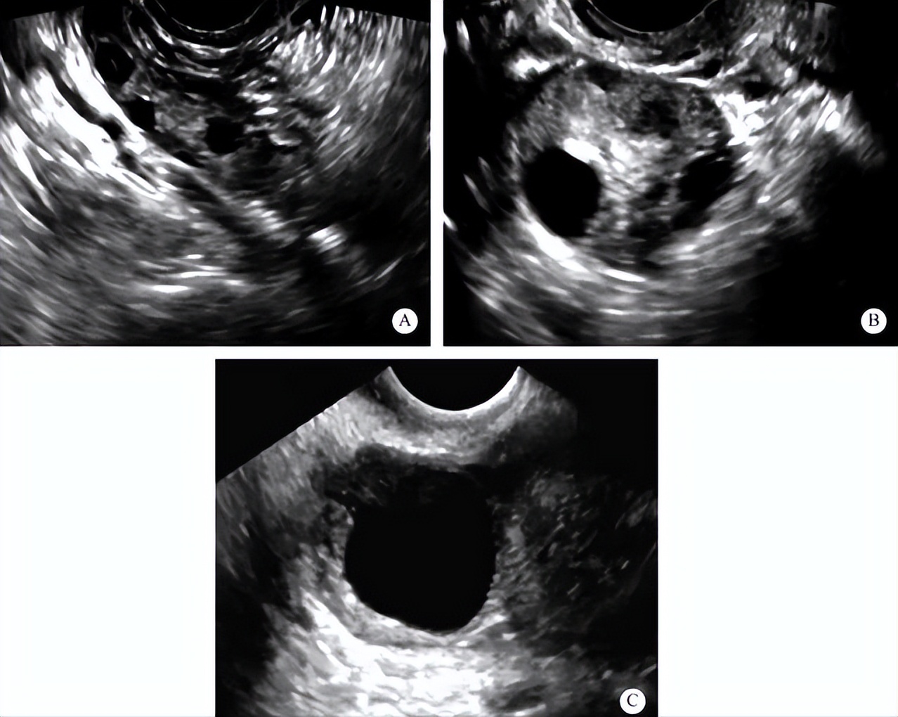 试管婴儿自然周期冻胚移植,试管婴儿冻胚移植自然周期流程