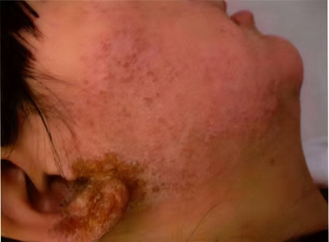 皮肤癣科普,非感染性亚急性湿疹