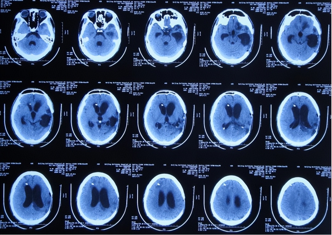 民间土方治疗脑中风,脑中风是什么原因和征兆