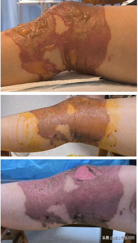 治疗60岁女性腿痛,多年腿疼治疗偏方大全