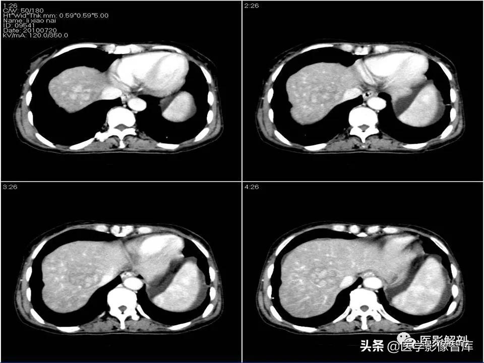肝炎性假瘤鉴别诊断,肝炎性假瘤影像学表现