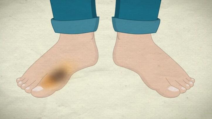 脚趾骨折断端稍分离移位,判断脚趾是骨折还是损伤的方法