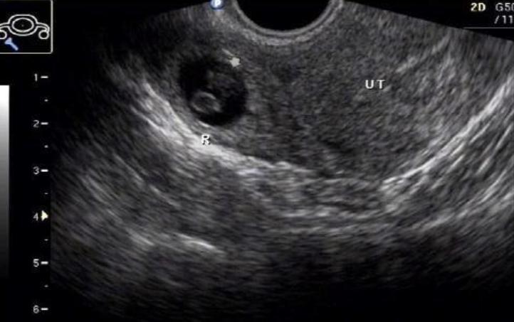 为什么现在越来越多宫外孕,宫外孕为啥这么多