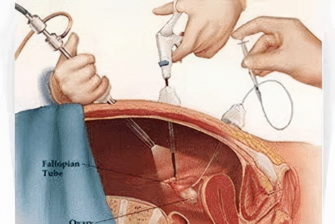 腹腔镜疝气手术多久可出院,腹腔镜微创疝气手术后20天了