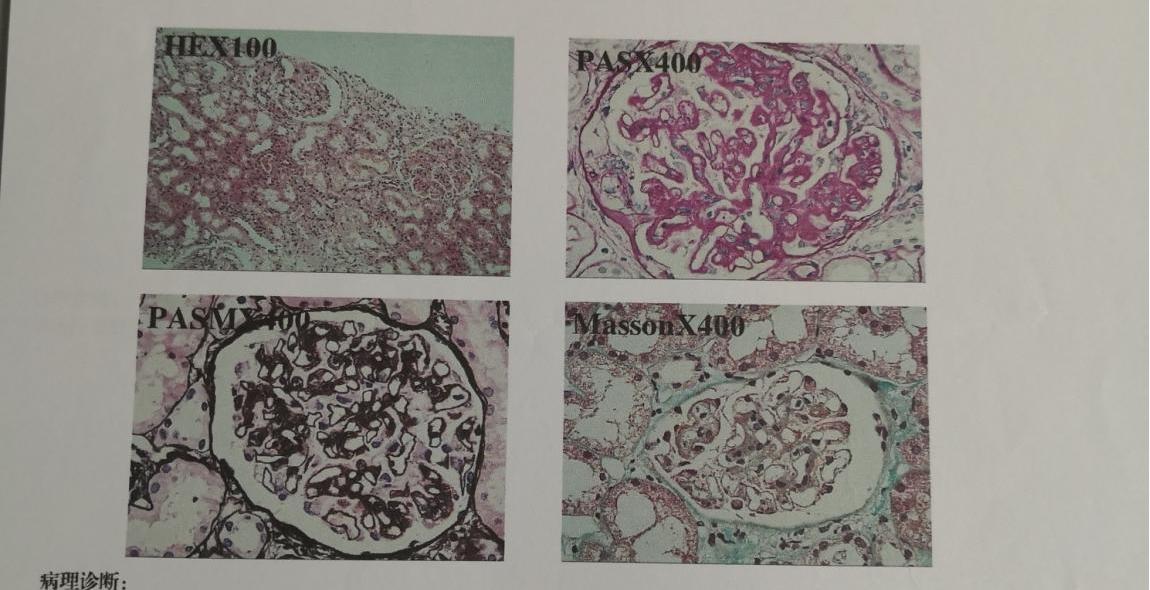 膜性肾病严重时患者会怎样,膜性肾病进展风险