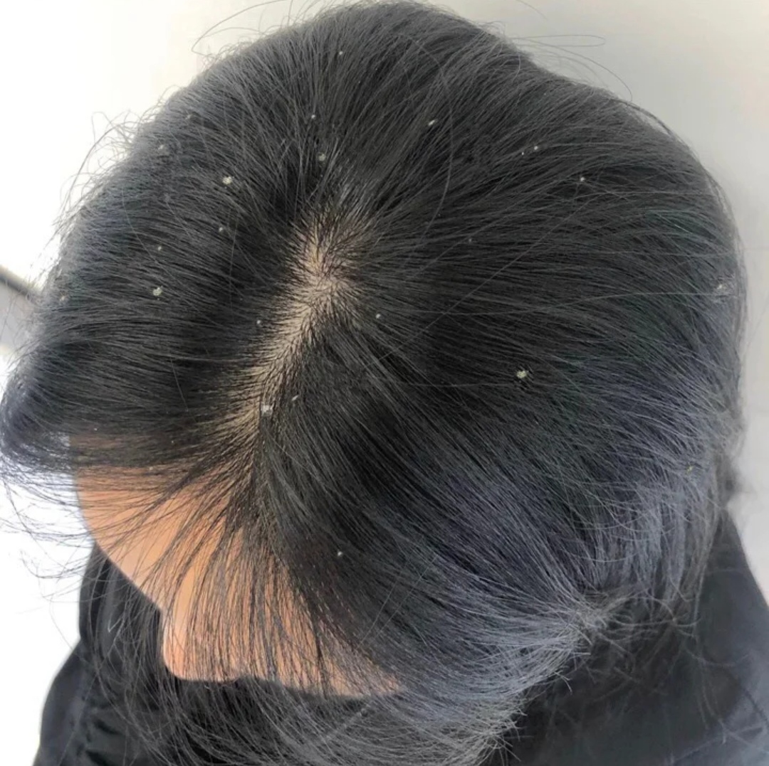 干性头皮屑去屑洗发水哪种最好,去头屑的洗发水哪一种最好