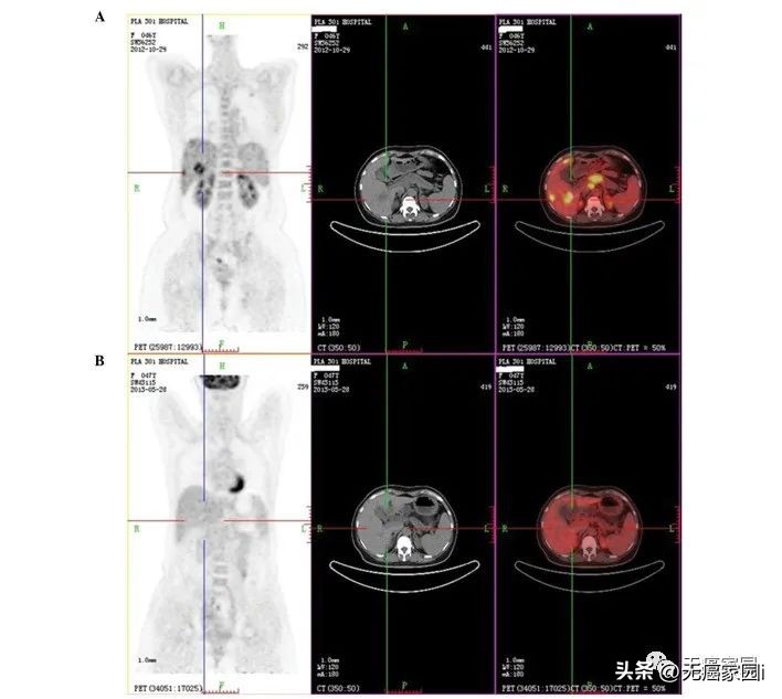 CAR-T、CAR-NK、癌症疫苗、TCR-T等细胞疗法，直击胰腺癌的软肋！