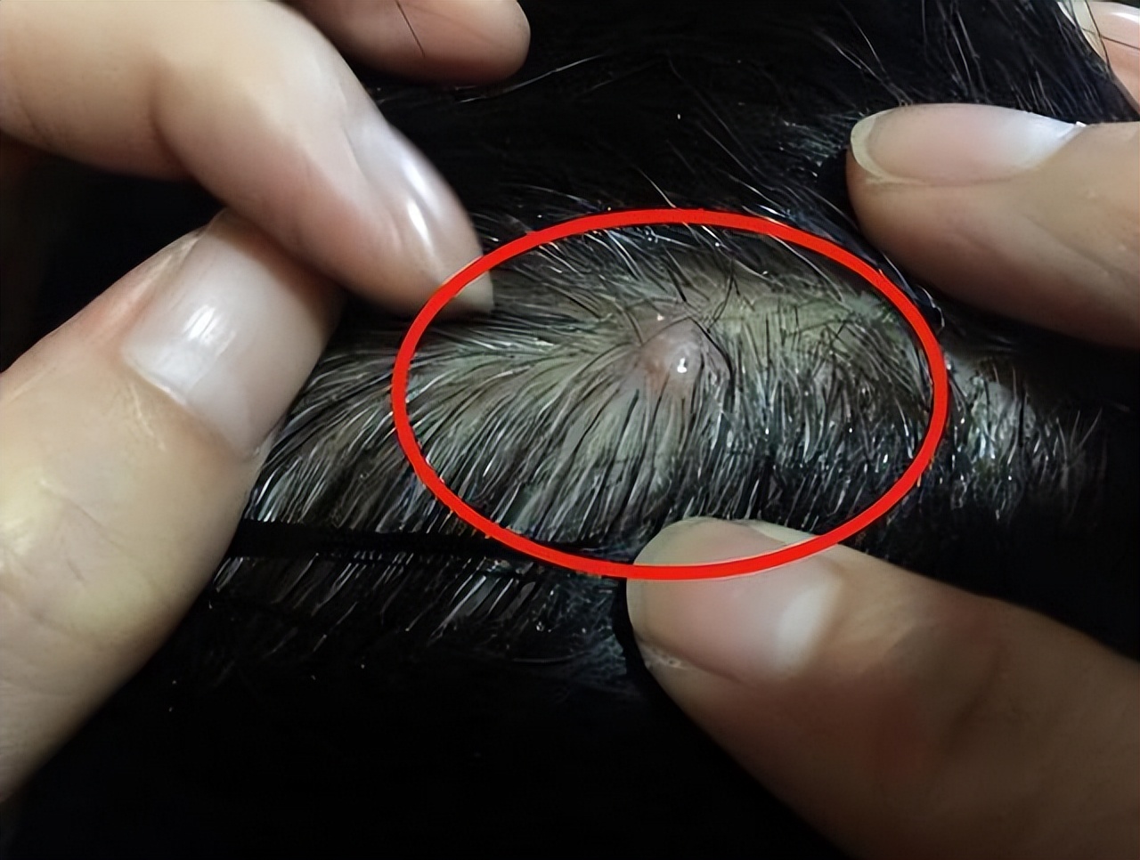 头皮长疙瘩脓包是什么原因,头皮长疙瘩或脓包有哪三种征兆