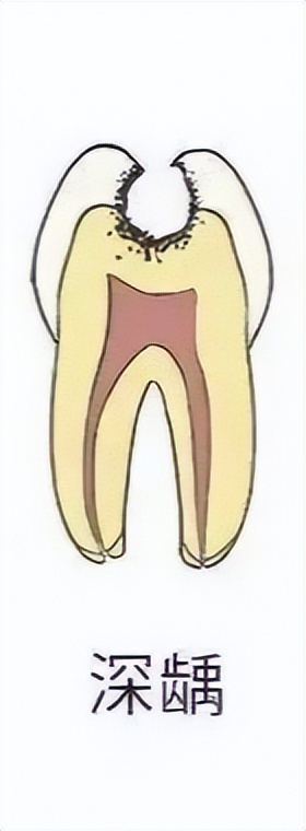 早期龋齿和中期龋齿的区别,科普口腔龋齿图片