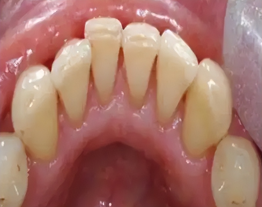 去牙渍牙黄的牙膏测评,能去牙结石的牙粉牙膏推荐