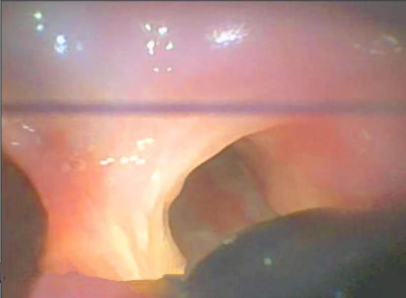 41年来首例!男子一咳就喷饭竟是食管、气管互通!医生胃镜、气管镜双镜齐下解罕见难题