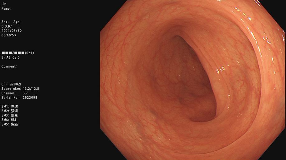 胶囊小肠镜检查前肠道准备,肠道排空十六小时肠镜前准备
