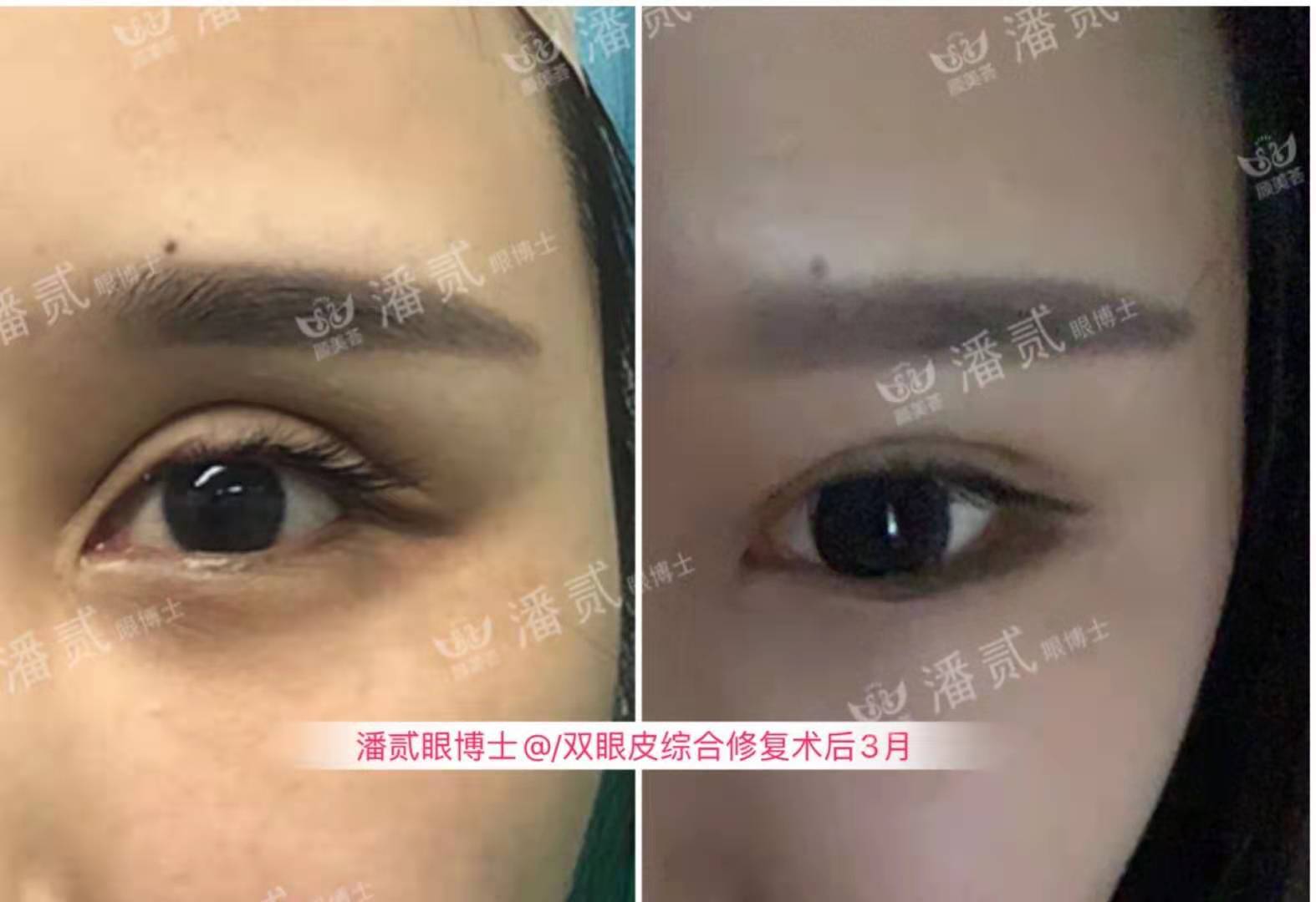 千万别被网红宽双眼皮*脑洗**了，对眉骨高眼窝深邃的人可能是灾难