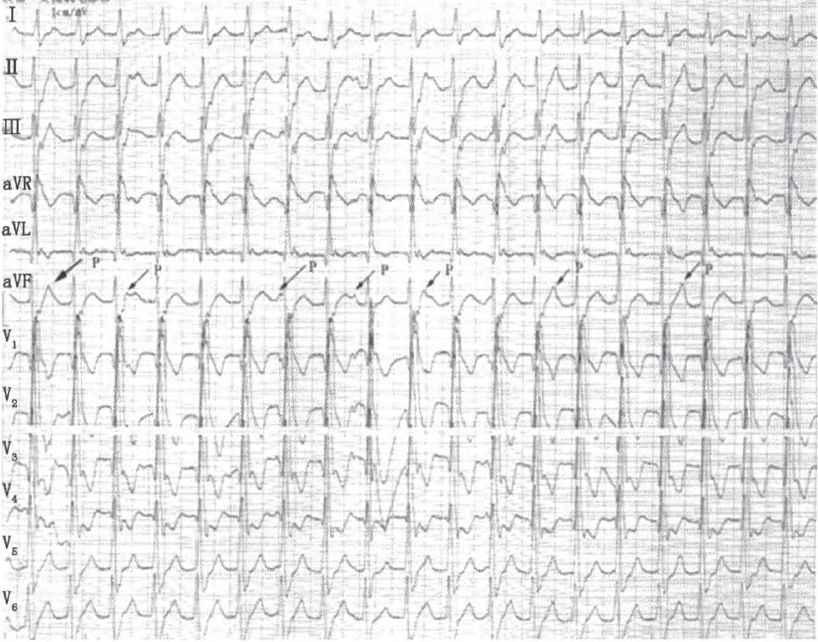 室性心动过速的五步鉴别方法,室性心动过速的诊断标准