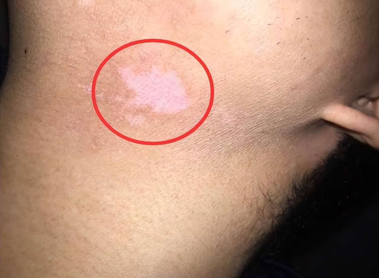 孩子脸上长白斑是怎么回事？是白癜风吗？要让娃吃“打虫药”吗？
