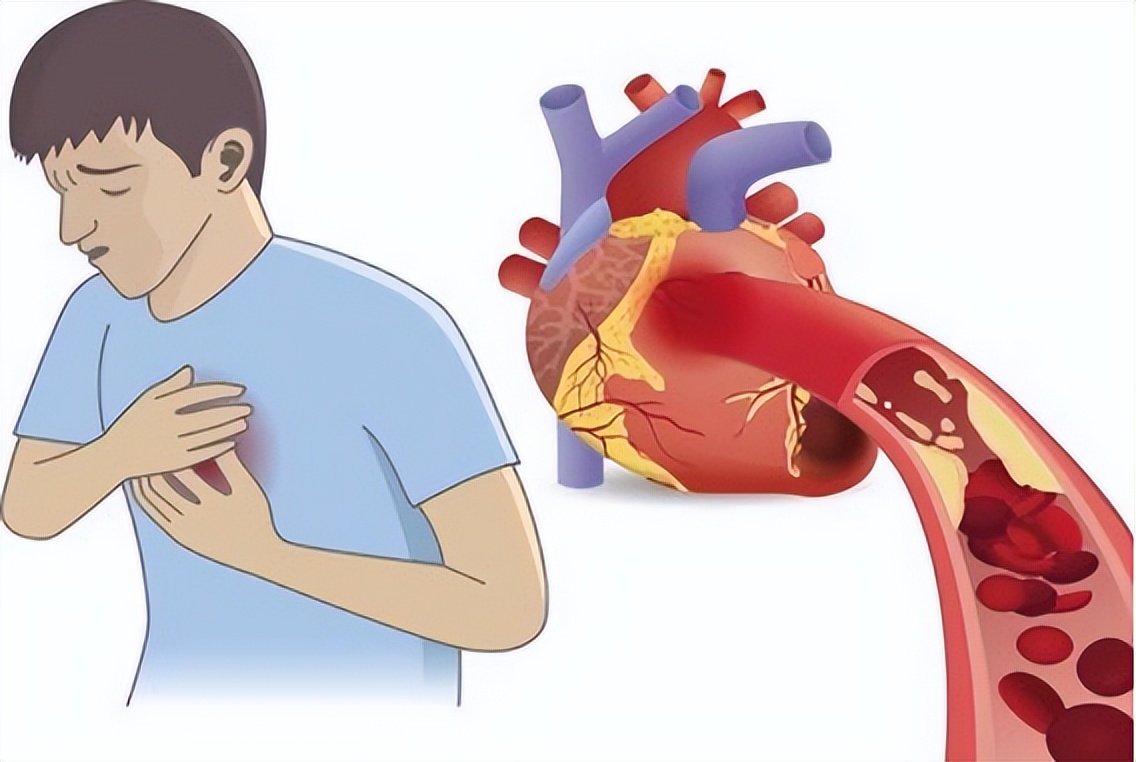 冠心病吃两种中成药效果最好,冠心病心肌缺血需要长期服药吗