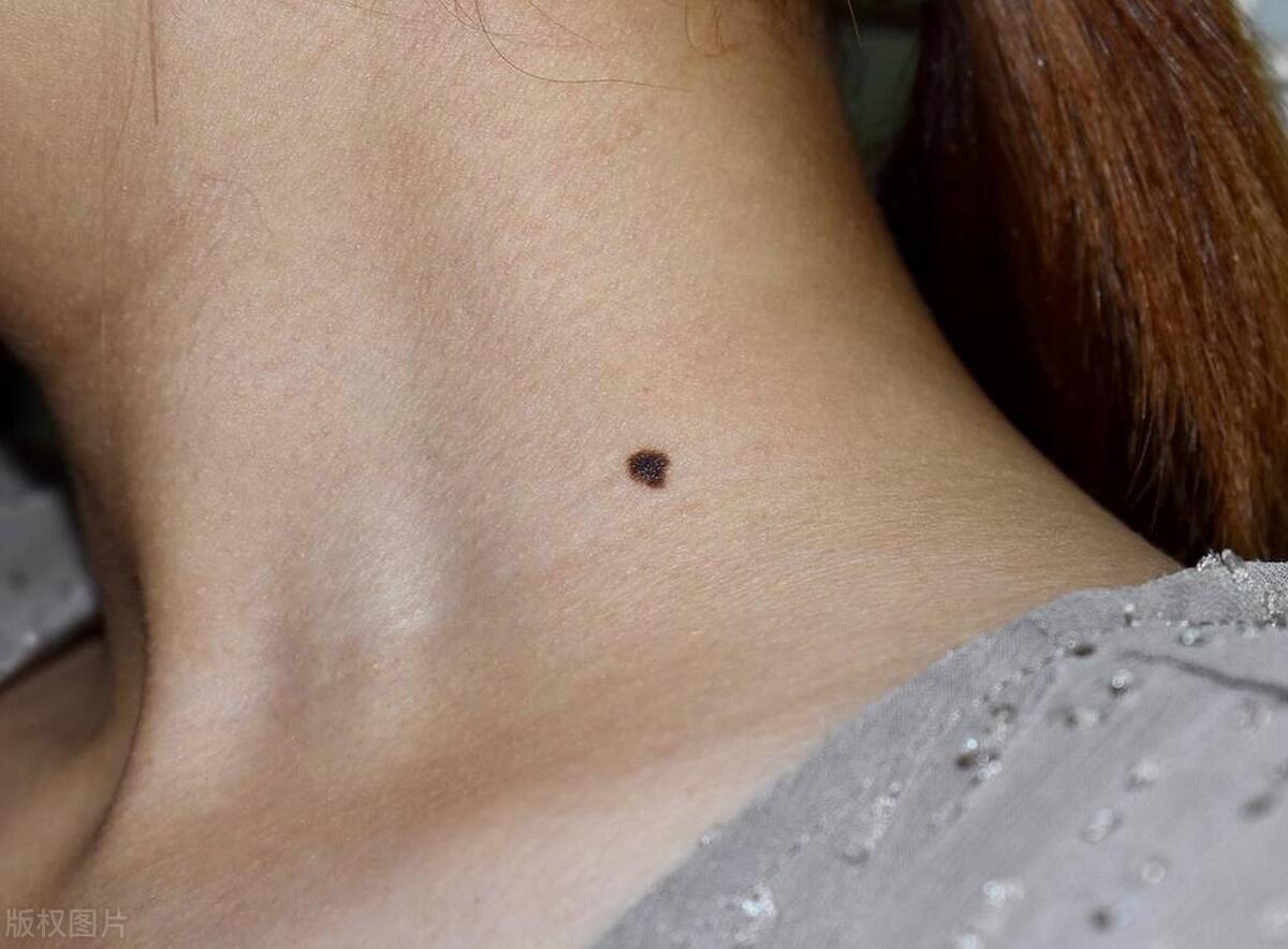 长在身体什么部位的痣容易癌变,脖子突然长痣是癌症的症状