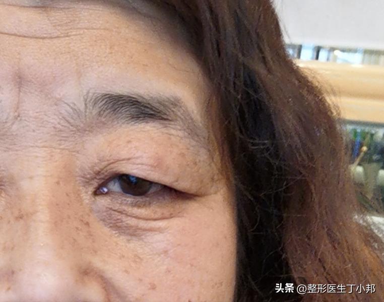 眼尾下垂眼综合可以调整吗,大小眼眼皮松弛怎么改善