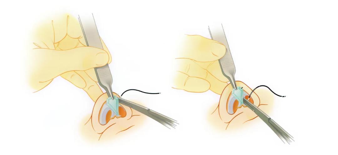 苏州韦敏隆鼻医生,九院韦敏隆鼻怎么样