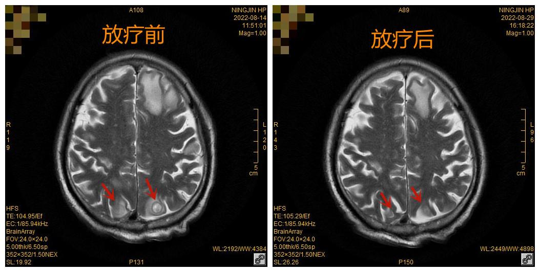 放疗治疗颈部癌症的效果,放疗根治食管癌