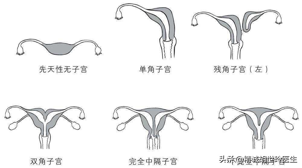 幼稚子宫能怀孕吗,始基子宫和幼稚子宫