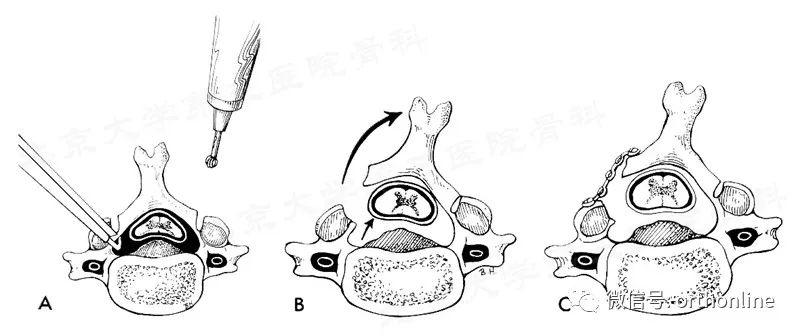 脊髓型颈椎病椎板成形术,椎间盘成形术指征