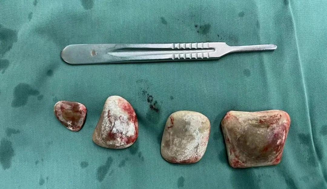 泌尿科治疗结石十大排行医院,治泌尿结石哪家好