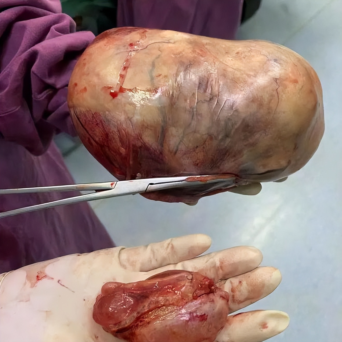 大同市第一人民医院为89岁高龄老人成功实施卵巢肿瘤手术