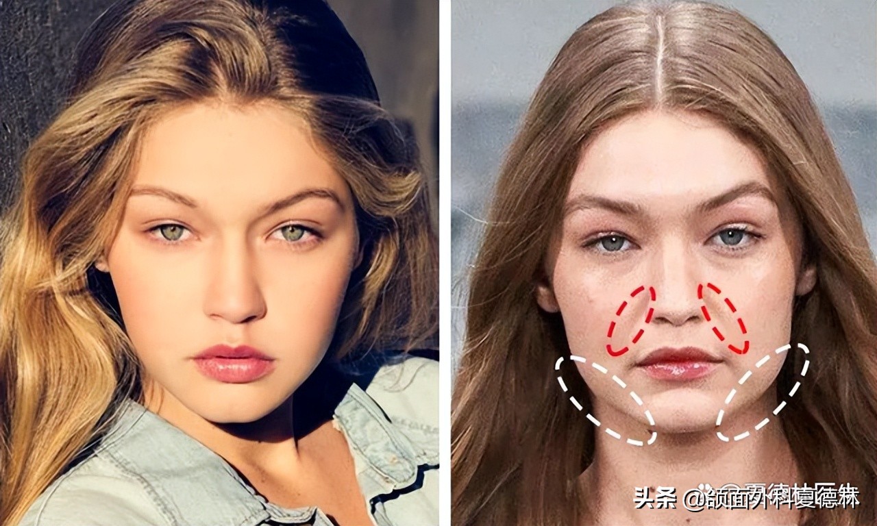 如何预防脸发腮,什么样的脸容易发腮