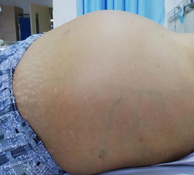 逆转肝硬化有诀窍走好这4步,肝硬化怎么才能逆转