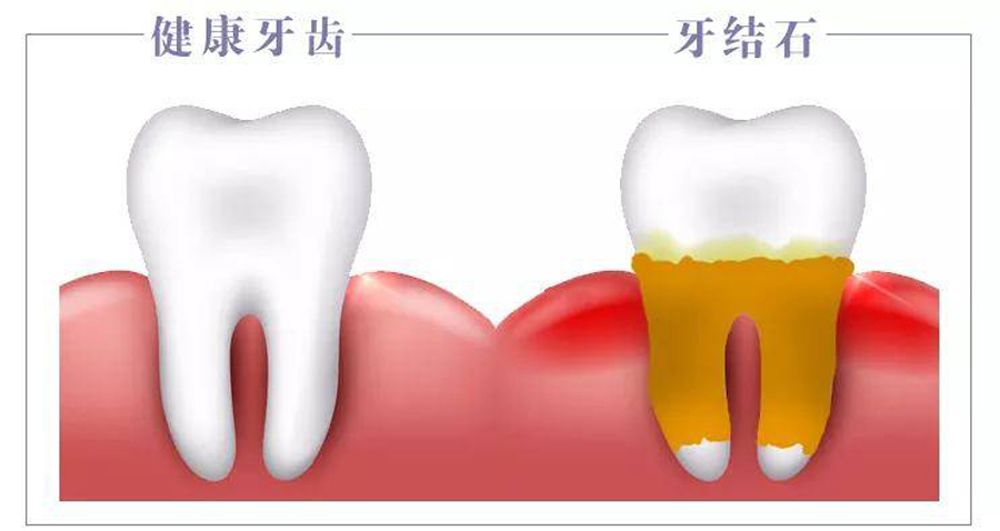 牙结石肾结石胆结石,肾结石胆囊结石牙结石