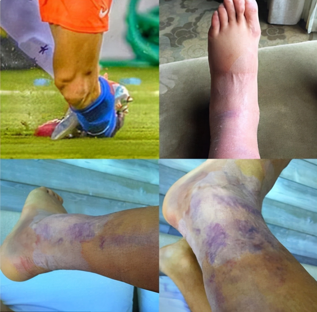 内马尔受伤是哪只脚,内马尔的脚伤