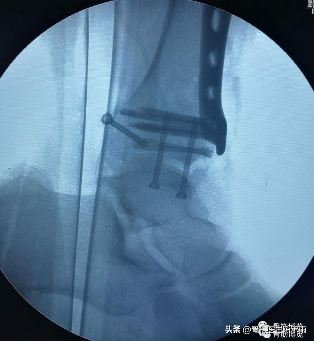 鑴氳笣楠ㄦ姌澶栧浐瀹氭敮鏋跺悗鎬庝箞鎭㈠,鑴氳笣楠ㄦ姌鐭宠啅鍜屽浐瀹氭敮鍏峰摢涓ソ