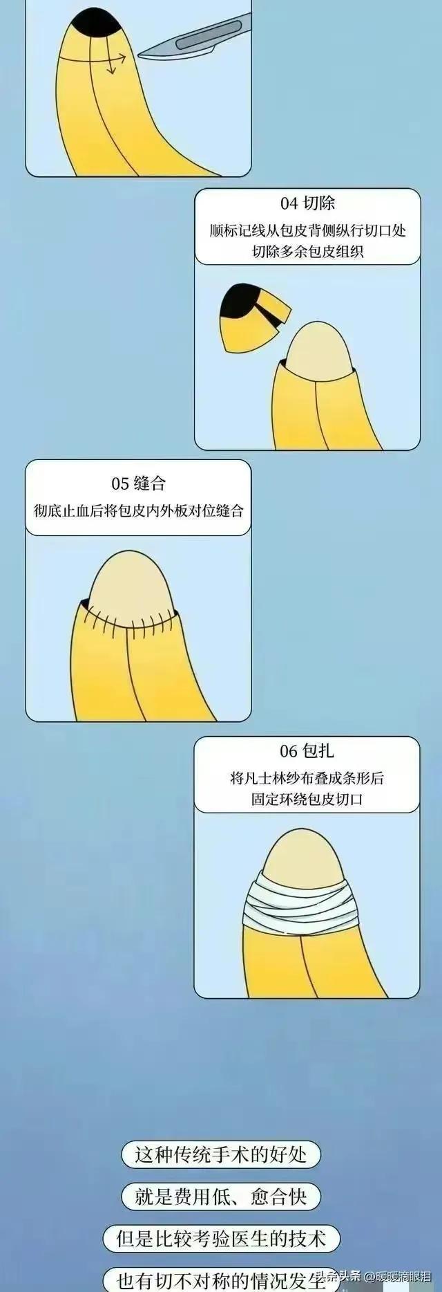 割完包皮会有什么变化,男生割过包皮之后有什么变化