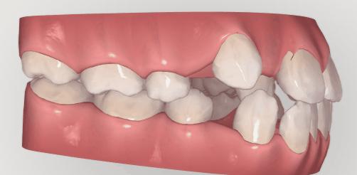 下巴后缩和下巴短怎么区分,下巴短小的原因