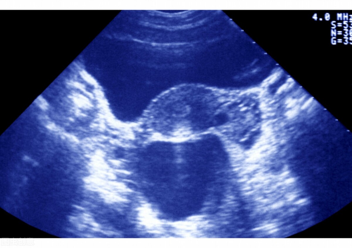 疑似输卵管有积水医生建议试管,未婚女子输卵管积水是否需要手术