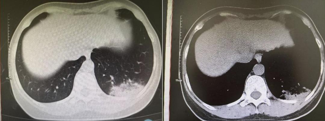 妇女高烧反复查不出原因,女子不明原因低热